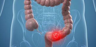 US Task Force recommended starting colorectal cancer screening to age 45