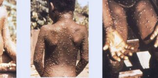 WHO expects more cases of monkeypox