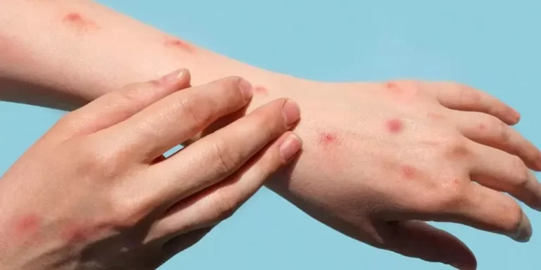 WHO experts give new  names for Monkeypox virus variants