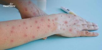 Tomato flu outbreak in India