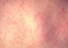 Measles Cases Reach 4,410 in US, CDC Reports