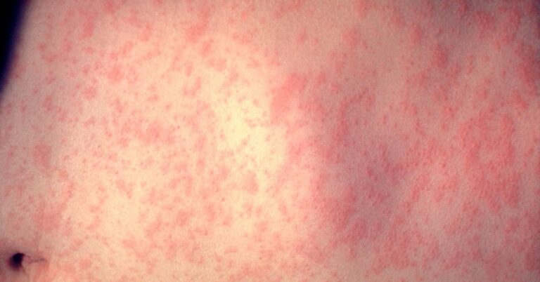 Measles Cases Reach 4,410 in US, CDC Reports