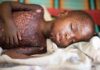 A child with measles, in a file photo