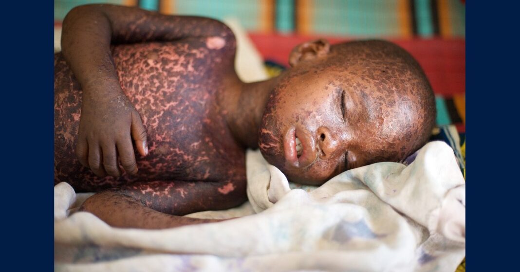 A child with measles, in a file photo