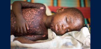 A child with measles, in a file photo